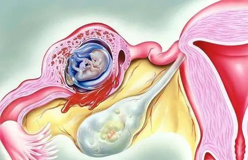 美国命试管婴儿中心助孕介绍这份试管流程攻略先收好